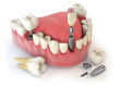 dental implants near me